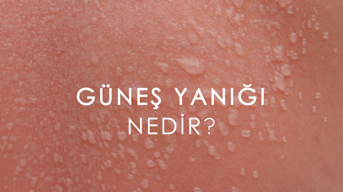 Güneş Yanığı Nedir? Güneş Yanığına Ne İyi Gelir?